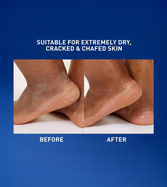https://www.cerave.com/-/media/project/loreal/brand-sites/cerave/americas/us/products/healing-ointment/healing-ointment-pdp-resizes/700x785/ho_before_after_r3-700x785-v1.jpg