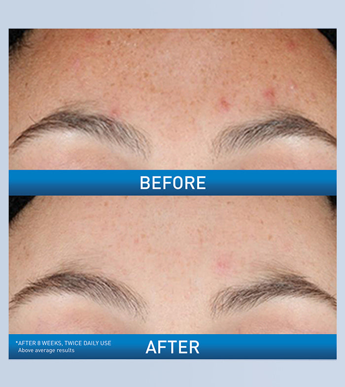 https://www.cerave.com/-/media/project/loreal/brand-sites/cerave/americas/us/skincare/serums/resurfacing-retinol-serum/retinol/desktop-700x785/retinol-ba-desktop-700x785-v1.jpg?rev=4c5e78451c2141a09b7061427cc3dcc2
